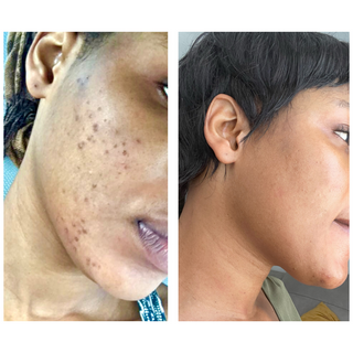 Intense Discoloration Treatment
