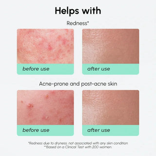 Redness Soothing Azelaic Acid Serum