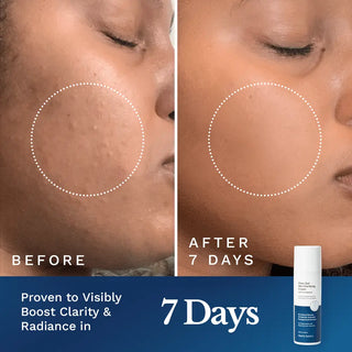 Clear Out Skin Clarifying Cream