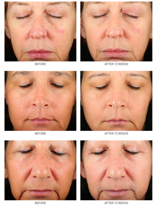 Retinoid Serum 2.5% & 5% | Advanced Anti-Aging Treatment WRI-LAX 5x