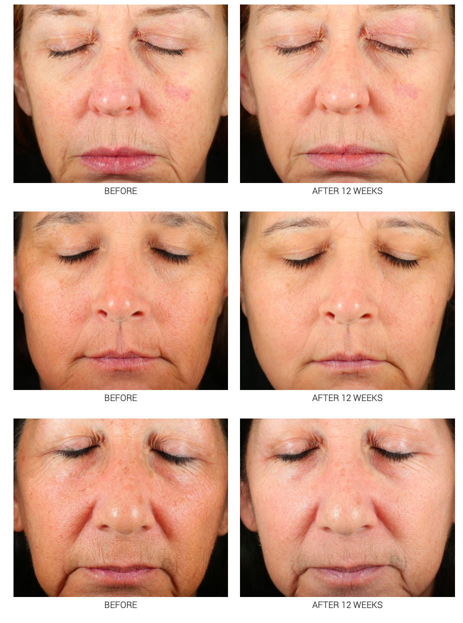 Retinoid Serum 2.5% & 5% | Advanced Anti-Aging Treatment WRI-LAX 5x