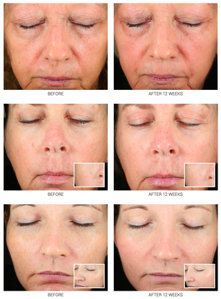 Retinoid Serum 2.5% & 5% | Advanced Anti-Aging Treatment WRI-LAX 5x